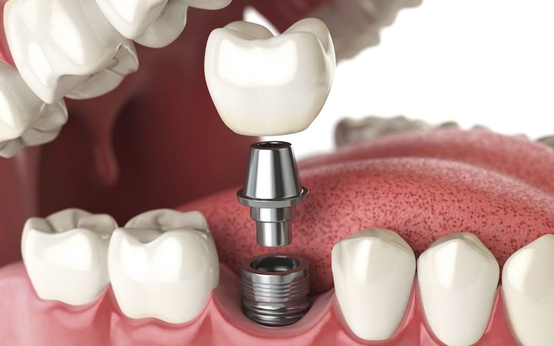 PHƯƠNG PHÁP CẤY GHÉP IMPLANT